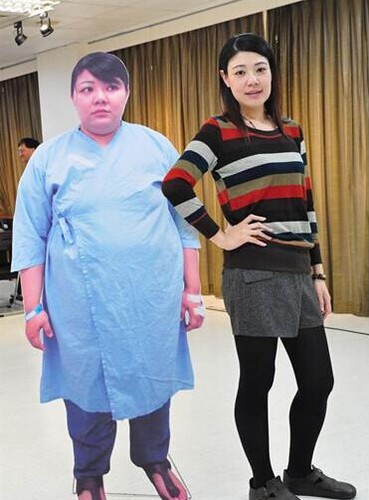 女子做缩胃手术一年半减54公斤变美女
