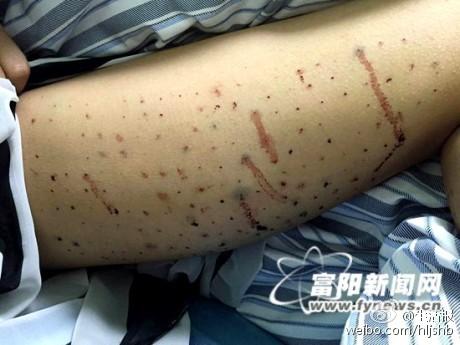 100斤女孩为减肥腿上被扎100多个窟窿