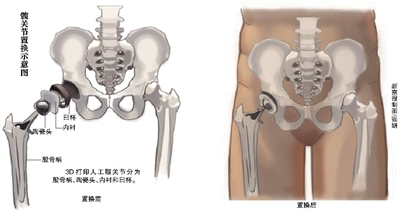 3D打印髋关节来了
