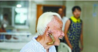 百岁老人脸长“羊角”