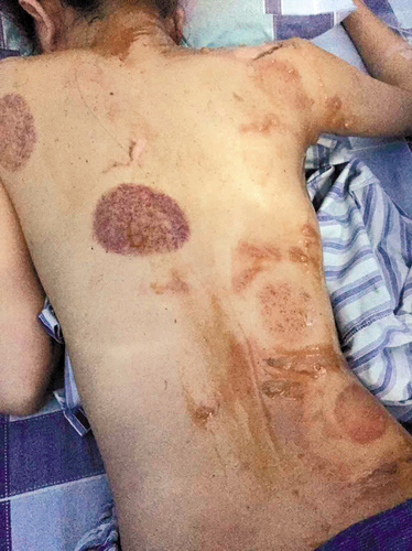 17岁少女拔火罐被烧伤背