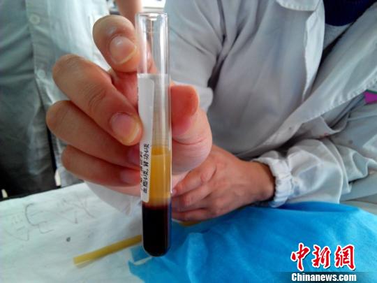男子节后抽血化验 一管血半管“油”